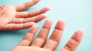Parmak Uçlarında Deri Soyulması Nedenleri Ve Tedavisi