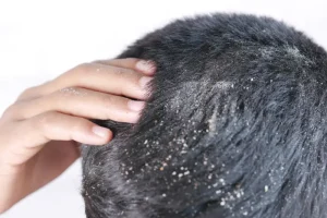 Saçta Deri Dökülmesi: Nedenleri, Belirtileri ve Etkili Tedavi Yöntemleri