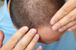 Saçta Deri Dökülmesi: Nedenleri, Belirtileri ve Etkili Tedavi Yöntemleri